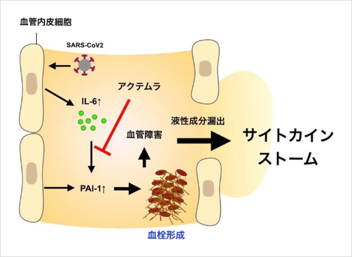 新型コロナウイルス感染による血管内でのサイトカインストーム発生の概念図。血中に増加したIL-6から放出されるPAI-1によって血栓が形成され、血管障害を引き起こしカインストームに至る。抗体医薬品「アクテムラ」でIL-6の働きを抑えることで症状の改善も見られた。※三菱財団 成果報告会講演資料より（提供：大阪大学）